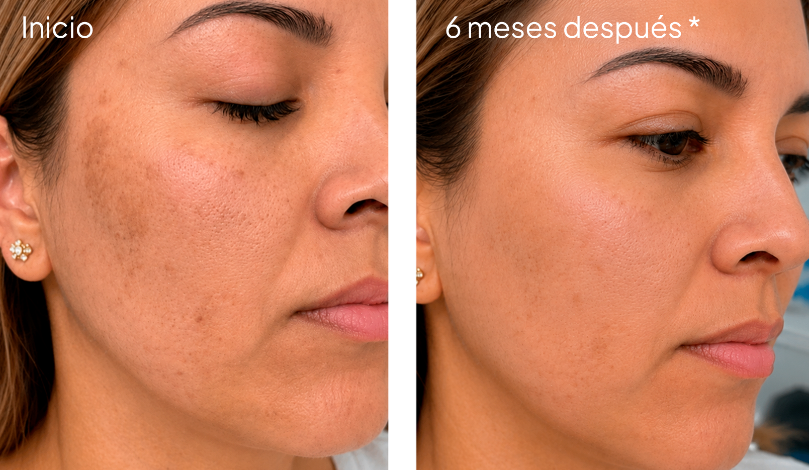 Resultado antes y despues de 6 meses de tratamiento dermatologico