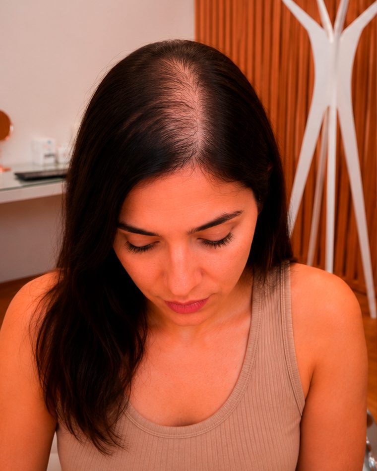 Paciente con caída del cabello antes y después de cuatro meses de tratamiento